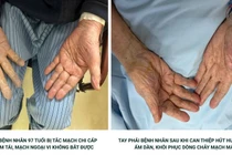 Tay lạnh, đau dữ dội, cụ bà 97 tuổi tắc mạch chi cấp do cục máu đông