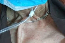 Tự cắt Catheter đường hầm lọc máu bệnh nhân chảy máu dữ dội