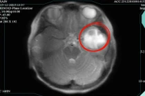 Buồn nôn đi khám, bé gái 9 tuổi bị áp xe não, phù não lan rộng