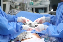 Cắt u máu gan kích thước lớn trong gan người phụ nữ hơn 10 năm