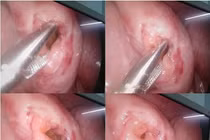 Bé trai 6 tuổi tím bụng, vỡ ruột khi đi xe đạp điện với bạn