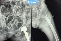 Đau nhiều vùng đùi, cụ bà 91 tuổi phải thay khớp háng vì gãy liên mấu chuyển 