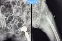 Đau nhiều vùng đùi, cụ bà 91 tuổi phải thay khớp háng vì gãy liên mấu chuyển 