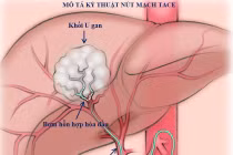 1/5 số ca ung thư ở nam giới là ung thư gan