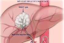1/5 số ca ung thư ở nam giới là ung thư gan
