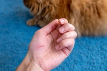 Bệnh nhân 71 tuổi tử vong vì chủ quan với vết mèo cào