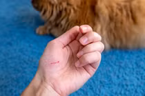 Bệnh nhân 71 tuổi tử vong vì chủ quan với vết mèo cào