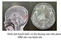 Nôn ói sau ăn, bé trai phát hiện huyết khối tĩnh mạch nội sọ