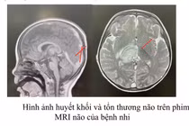 Nôn ói sau ăn, bé trai phát hiện huyết khối tĩnh mạch nội sọ