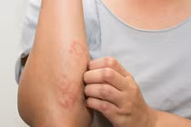 Viêm mao mạch dị ứng, nhận biết đúng để phòng tránh biến chứng