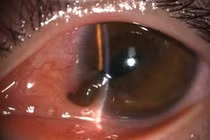 Thủng nhãn cầu vì vô tình bóp cò súng bắn đinh