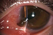 Thủng nhãn cầu vì vô tình bóp cò súng bắn đinh