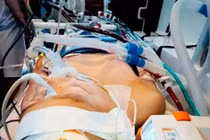 Dị dạng động tĩnh mạch… nguy cơ tử vong cao