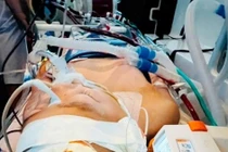 Dị dạng động tĩnh mạch… nguy cơ tử vong cao