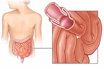 Đau bụng và khóc, trẻ 1 tuổi lồng ruột nguy kịch