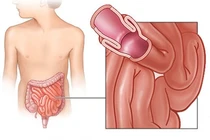 Đau bụng và khóc, trẻ 1 tuổi lồng ruột nguy kịch