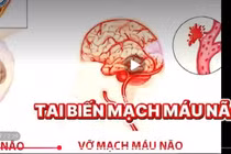 Bác sĩ mách cách dự phòng bệnh mạch vành do tăng huyết áp