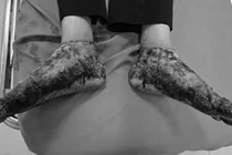 Ngâm nước lá nóng điều trị viêm da cơ địa, người bệnh bị bỏng nặng hai chân