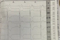 Cao gầy, sụp mí mắt, chàng trai 19 tuổi mắc hội chứng Kearns–Sayre hiếm gặp