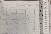 Cao gầy, sụp mí mắt, chàng trai 19 tuổi mắc hội chứng Kearns–Sayre hiếm gặp