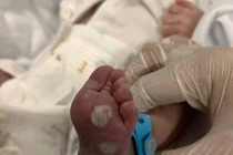 Bé sơ sinh suy hô hấp, gan lách to vì mẹ không tầm soát giang mai thai kỳ