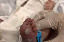 Bé sơ sinh suy hô hấp, gan lách to vì mẹ không tầm soát giang mai thai kỳ