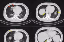Người đàn ông 63 tuổi mắc đồng thời ung thư phổi và tuyến tiền liệt
