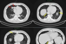 Người đàn ông 63 tuổi mắc đồng thời ung thư phổi và tuyến tiền liệt