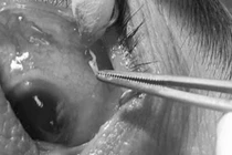 Mắt đỏ cộm, người phụ nữ 67 tuổi không ngờ ký sinh trùng trong mắt