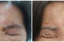 Đối tượng cần tiêm vắc xin Zona tránh biến chứng nặng