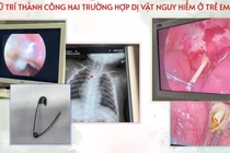 Thích ăn kẹo mút, trẻ viêm phúc mạc nặng vì que kẹo đâm thủng tá tràng