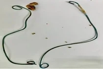 Bỏ quên không rút thông JJ khiến sỏi thận bám đầy