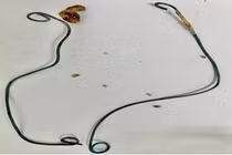 Bỏ quên không rút thông JJ khiến sỏi thận bám đầy