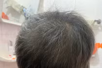 Bé gái rụng trọc tóc vì bệnh tự miễn, thuốc ức chế Janus kinase giúp phục hồi