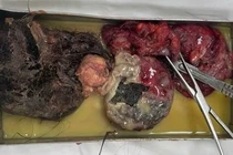 Cấp cứu bệnh nhân có khối u nang buồng trứng quái vỡ chứa răng và tóc