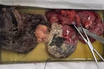 Cấp cứu bệnh nhân có khối u nang buồng trứng quái vỡ chứa răng và tóc