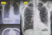 Cứu sống ngoạn mục cụ ông 96 tuổi chấn thương nặng do ngã