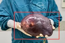 Cắt khối u gan khổng lồ chiếm 70% diện tích gan cho người đàn ông 36 tuổi