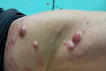 Sẩn cục bất thường ở da không ngờ u ác tính