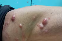 Sẩn cục bất thường ở da không ngờ u ác tính