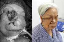 Lấy u khổng lồ vùng mặt cho cụ bà 96 tuổi