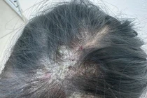 Trẻ 10 tuổi áp xe viêm mủ từng mảng da đầu do nấm