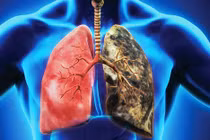 Mỗi điếu thuốc là kho chứa độc tố với hơn 7000 hóa chất, 70 chất gây ung thư