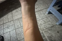 Đập tay vào kính lúc nóng giận, hai người suýt hỏng tay vĩnh viễn 