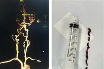 Đi viện điều trị đau bụng, cụ bà 75 tuổi đột quỵ