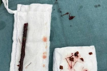 Bé gái 3 tuổi mang cành cây dài 16cm trong bụng suốt 4 tháng