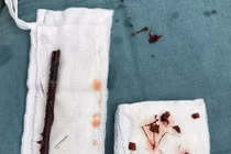 Bé gái 3 tuổi mang cành cây dài 16cm trong bụng suốt 4 tháng