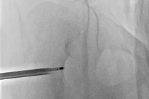 Đau dữ dội chân, bé gái 7 tuổi bị u xương hiếm gặp