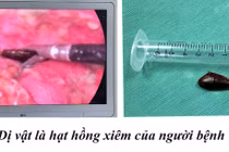 Lấy hóc dị vật xương cá cho trẻ 12 tuổi và hạt hồng xiêm cho cụ ông 85 tuổi