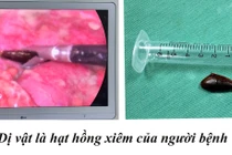 Lấy hóc dị vật xương cá cho trẻ 12 tuổi và hạt hồng xiêm cho cụ ông 85 tuổi